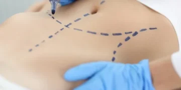 تكلفة استئصال المعدة في إيران