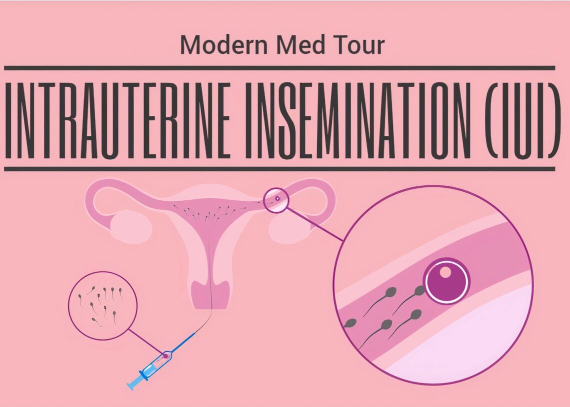 إيران تقدم أسعارًا تنافسية للغاية لعلاج التلقيح داخل الرحم (IUI)، حيث تتراوح التكلفة في إيران عادة بين 100 دولار و 250 دولار. بالمقارنة مع الولايات المتحدة الأمريكية، حيث تصل تكلفة IUI إلى مستويات أعلى تتراوح بين 500 دولار و1000 دولار، يمكن أن نستنتج أن إيران ليست فقط توفر العلاج بجودة عالية وفعالية، ولكنها تقدم ذلك بتكلفة أقل بكثير مما هو متاح في الولايات المتحدة. هذا يجعل إيران وجهة مثالية للأزواج الذين يبحثون عن العلاج بأسعار معقولة للإخصاب داخل الرحم (IUI)، وذلك دون الحاجة إلى التضحية بالجودة أو التأخير في بدء عملية العلاج.