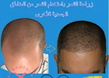 کاشت مو با واحد ریشه برداشت شده از بدن (BHT)