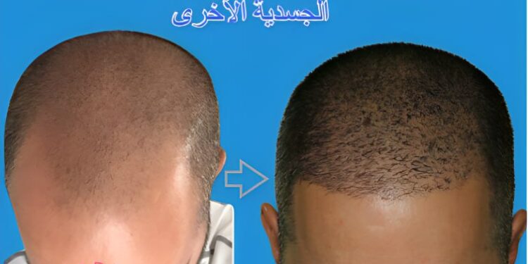 زراعة الشعر (BHT)