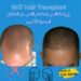 زراعة الشعر (BHT)