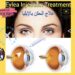 علاج حقن إيليا(Eylea Injection): تعريف وأنواعه في إيران