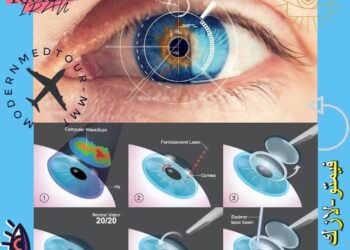 الفيمتو لاسيك(Femto-LASIK): تعريف وأنواعه في إيران