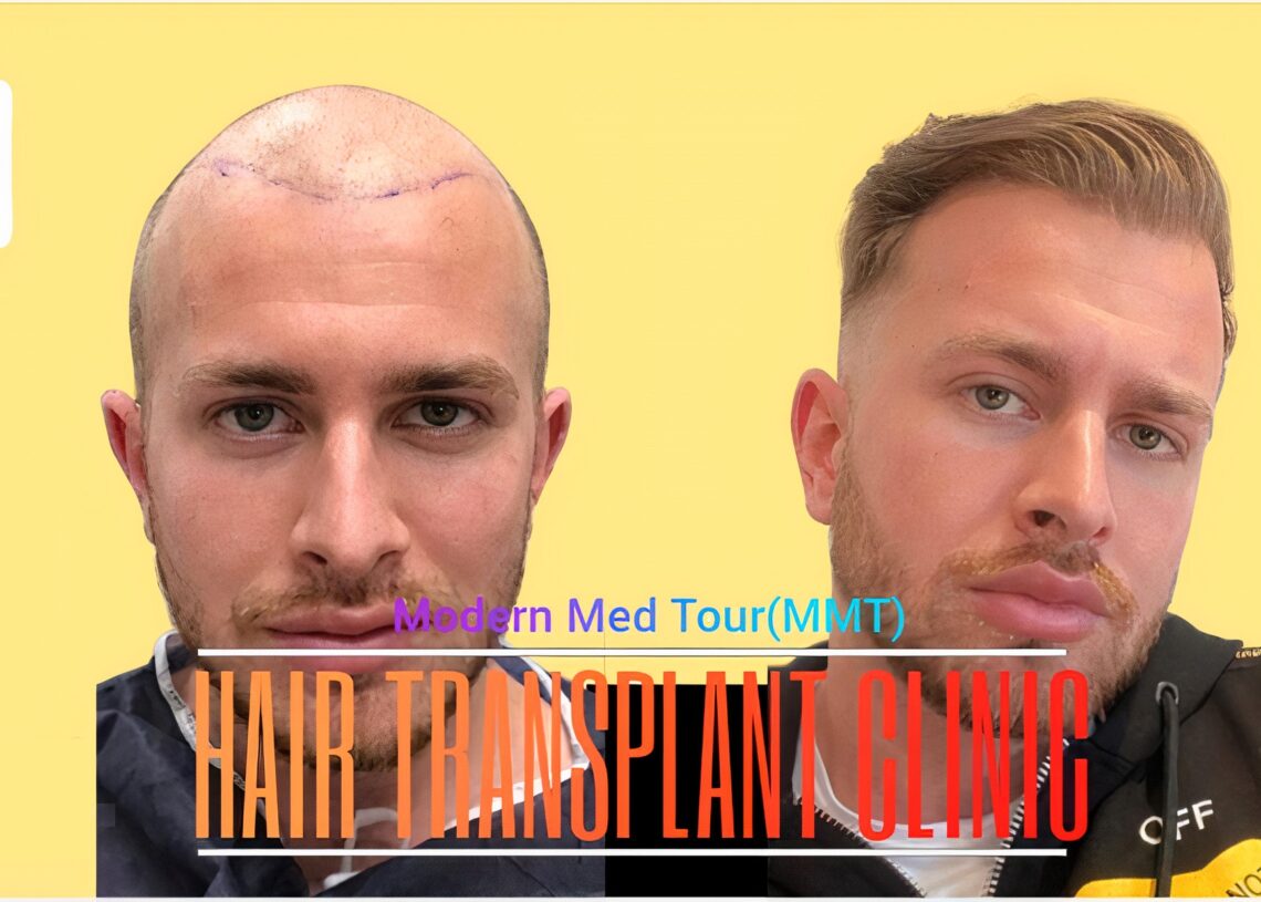 إيران تبرز كوجهة رائدة عالمية لزراعة الشعر في الرأس، حيث تقدم هذه الخدمة بتكاليف أكثر بأمانة بكثير مقارنة بالعديد من البلدان الأخرى. بينما تبلغ تكاليف زراعة الشعر في الرأس في الولايات المتحدة الأمريكية والمملكة المتحدة وإيطاليا مستويات مرتفعة تصل إلى الآلاف من الدولارات، تتراوح التكاليف في إيران بين 1000 و2000 دولار. هذا يتيح للمرضى الاستفادة من نفس الجودة والكفاءة العالية في الخدمة الطبية، مما يجعل إيران وجهة مفضلة للعديد من الأشخاص الباحثين عن إجراء زراعة الشعر. مع الأسعار المعقولة والخبرة الطبية الممتازة، تعتبر إيران الخيار الأفضل على الصعيدين الاقتصادي والجودة لزراعة الشعر في العالم.