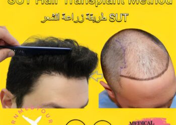 أسلوب زراعة الشعر SUT
