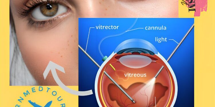 الفيتركتومي(Vitrectomy): الأنواع والتعريف