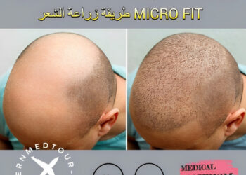 طريقة زراعة الشعر MICRO FIT