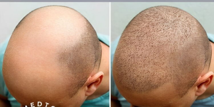 طريقة زراعة الشعر MICRO FIT