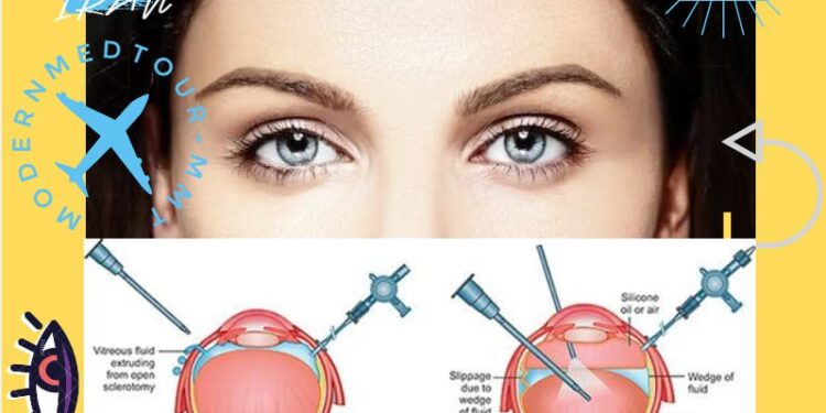 حقن الزيت السيليكوني داخل الزجاجية(Intravitreal Silicone Oil Injection): التعريف والأنواع