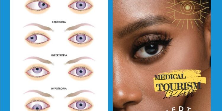 جراحة تقويم العيون (Strabismus): استعادة التوازن البصري