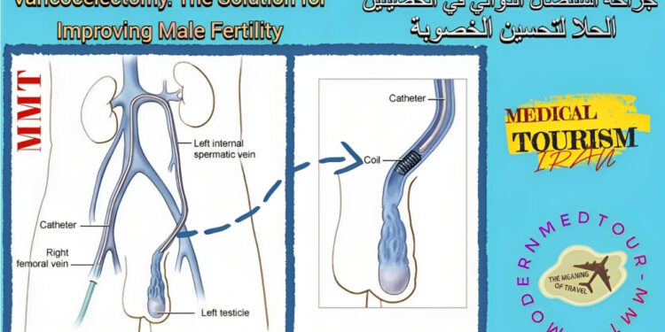 جراحة الوريد الدوالي الخصية (Varicocelectomy): تعريف وأنواع