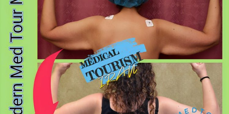 رفع الذراع (Arm Lift) في إيران