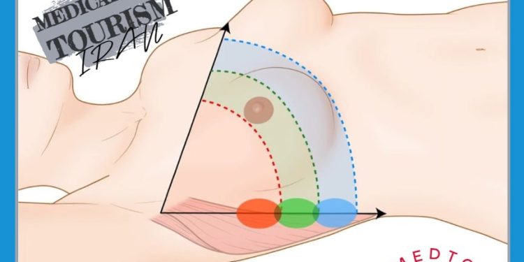 جراحة إعادة بناء الثدي (Breast reconstruction surgery) في إيران