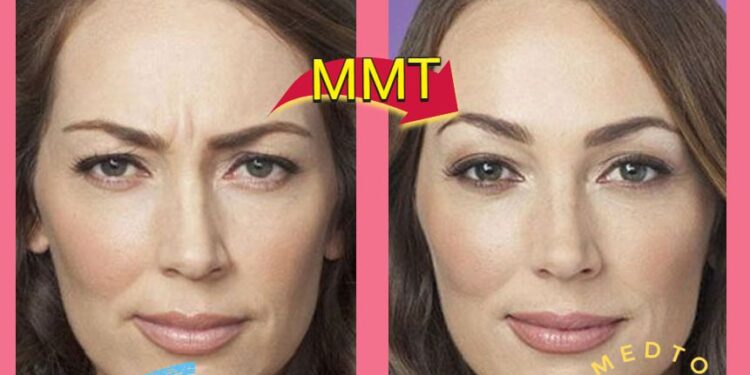 رفع الحاجب (Brow Lift) في إيران