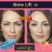 رفع الحاجب (Brow Lift) في إيران