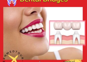 الجسور السنية(Dental Bridges): تعريف وأنواع