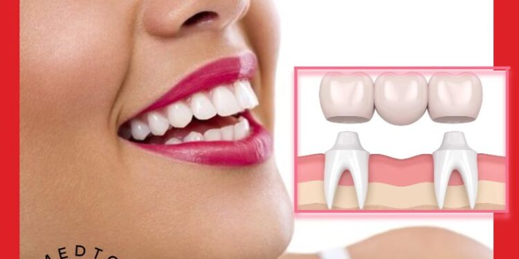 الجسور السنية(Dental Bridges): تعريف وأنواع