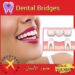 الجسور السنية(Dental Bridges): تعريف وأنواع