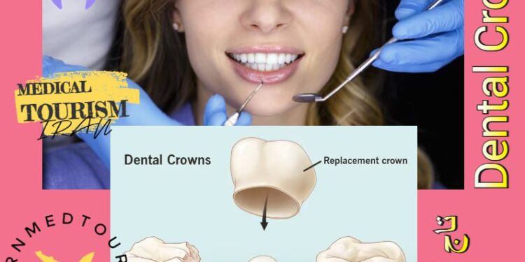تيجان الأسنان (Dental Crowns) تعريف وأنواع