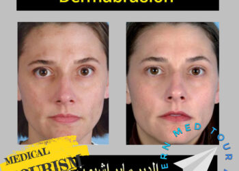 التقشير الجلدي (Dermabrasion) في إيران