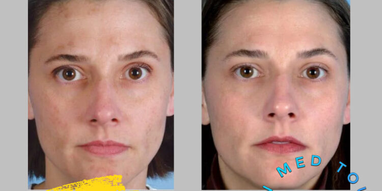 التقشير الجلدي (Dermabrasion) في إيران