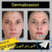 التقشير الجلدي (Dermabrasion) في إيران