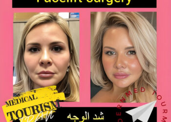 شد الوجه(Facelift)