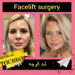 شد الوجه(Facelift)