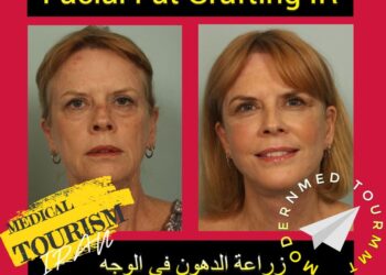 زراعة الدهون في الوجه(Facial Fat Grafting): أنواعها وتعريفها في إيران