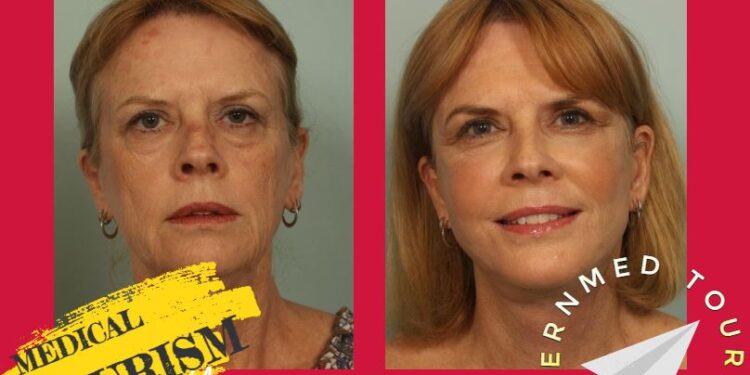 زراعة الدهون في الوجه(Facial Fat Grafting): أنواعها وتعريفها في إيران