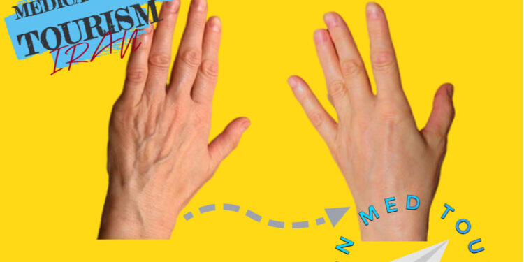 تجديد اليدين (Hand rejuvenation Surgery) في إيران