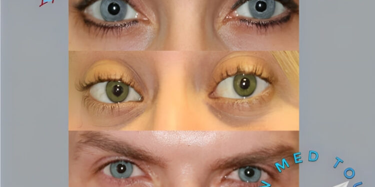 رأب القزحية(Iridoplasty): أنواع وتعريف في إيران