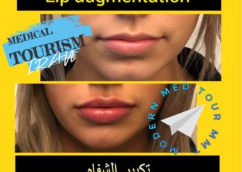 زراعة الشفاه (Lip Augmentation) في إيران