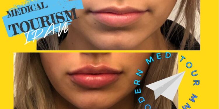 زراعة الشفاه (Lip Augmentation) في إيران