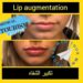 زراعة الشفاه (Lip Augmentation) في إيران