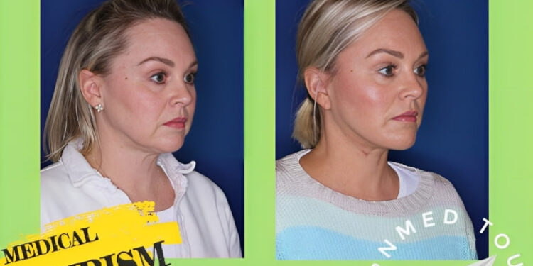 رأب العضلة العاصرة(Platysmaplasty): أنواعه وتعريفه في إيران