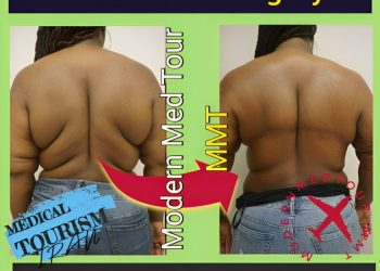 شد الترهلات (Post-Bariatric Surgery) في إيران