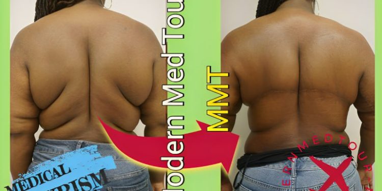 شد الترهلات (Post-Bariatric Surgery) في إيران