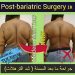 شد الترهلات (Post-Bariatric Surgery) في إيران