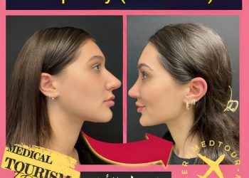 تجميل الأنف(Rhinoplasty) في إيران