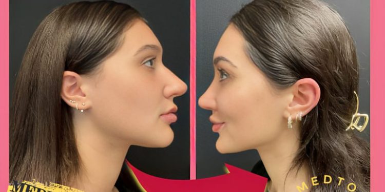 تجميل الأنف(Rhinoplasty) في إيران