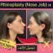 تجميل الأنف(Rhinoplasty) في إيران