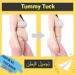 تجميل البطن (Tummy Tuck)