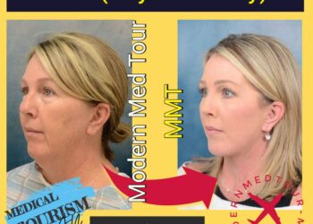 شد الوجه( Facelift) في إيران