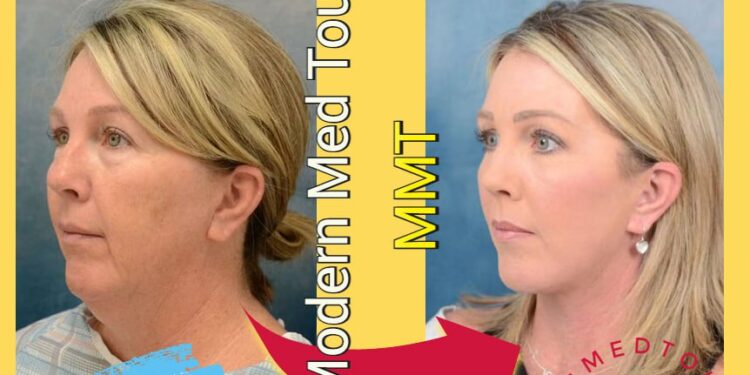 شد الوجه( Facelift) في إيران