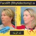 شد الوجه( Facelift) في إيران