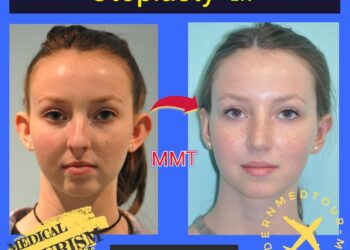 رأب الأذن(otoplasty): التعريف والأنواع في إيران