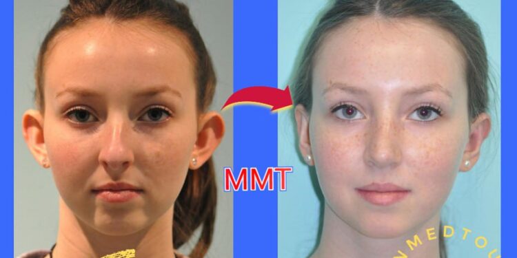 رأب الأذن(otoplasty): التعريف والأنواع في إيران