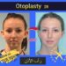 رأب الأذن(otoplasty): التعريف والأنواع في إيران