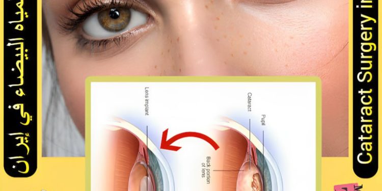 جراحة المياه البيضاء (Cataract surgery) في إيران